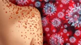 Ghana : 21 nouveaux cas de mpox signalés